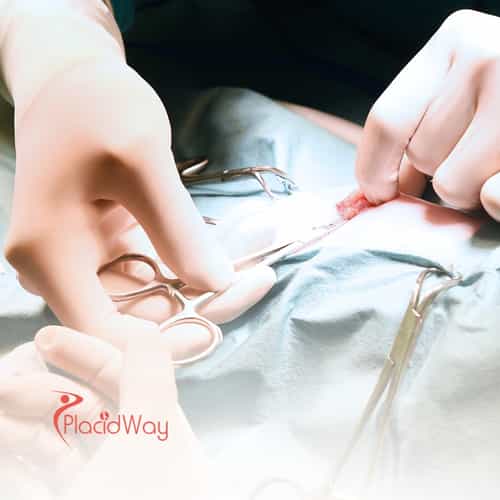 Penile Surgery in Germany: High-Quality Urology Services for Middle Eastern Men with Erectile Dysfunction